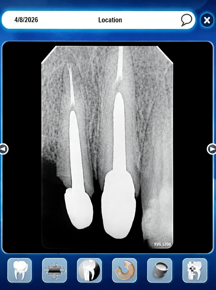 increase-the-length-of-post-and-core-for-two-teeth-scmfhqg0d