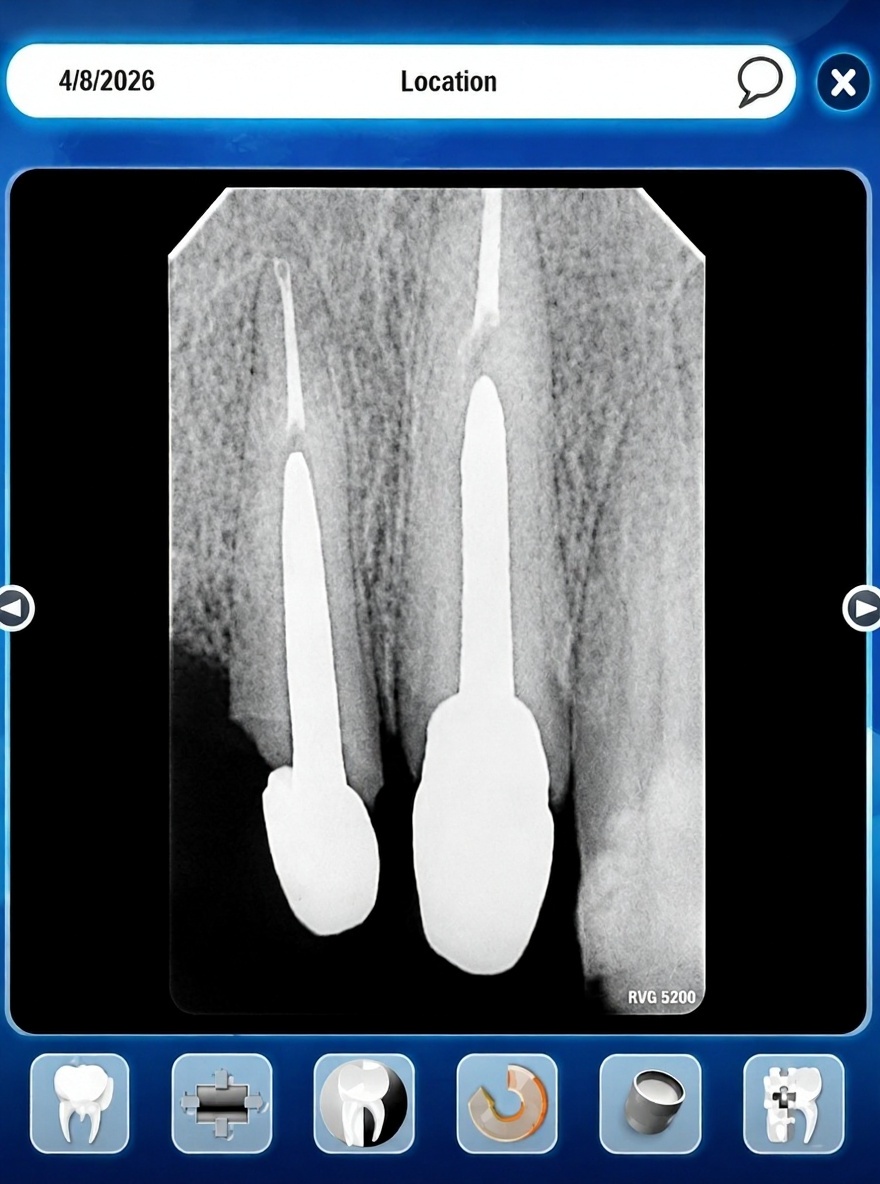 increase-the-length-of-post-and-core-about-3mm-for-lziwuw5ph